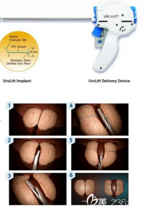 前列腺肥大Urolift微創(chuàng)手術(shù)