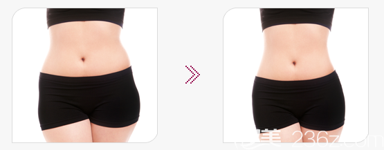 韓國(guó)光明整形外科吸脂手術(shù)案例 韓國(guó)光明整形外科吸脂手術(shù)案例