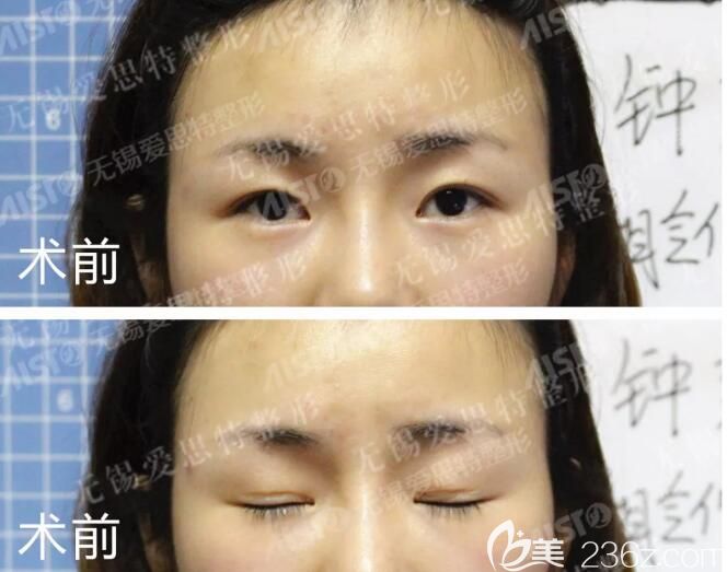 面診無錫愛思特術(shù)前失敗雙眼皮 面診無錫愛思特術(shù)前失敗雙眼皮