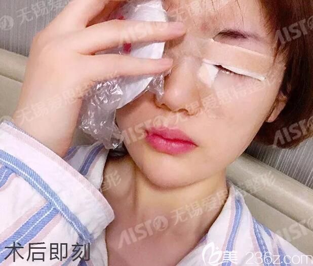 剛做完雙眼皮失敗修復(fù)術(shù)后即刻冰敷消腫 剛做完雙眼皮失敗修復(fù)術(shù)后即刻冰敷消腫