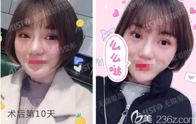 程寧新分享術(shù)后十天眼部修復(fù)恢復(fù)情況 程寧新分享術(shù)后十天眼部修復(fù)恢復(fù)情況