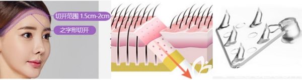 韓國TJ整形外科額頭縮小手術(shù)過程