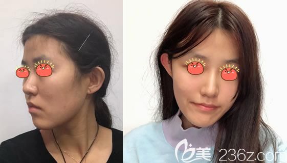 嘉興曙光自體脂肪豐蘋(píng)果肌<span style= 嘉興曙光自體脂肪豐蘋(píng)果肌<span style=