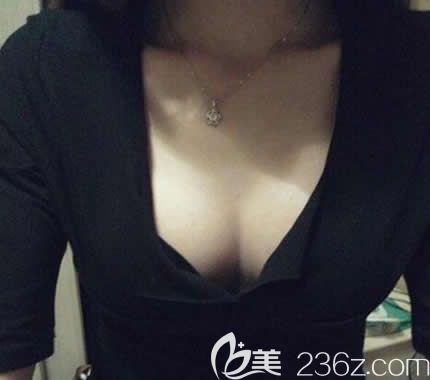 自卑的平胸妹在北海韓美整形做曼托水滴形毛面假體隆胸40天后,變的自信滿滿