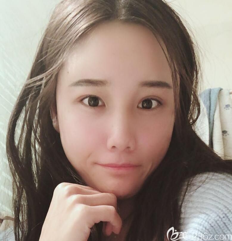 脂肪填充全臉術(shù)后第3天