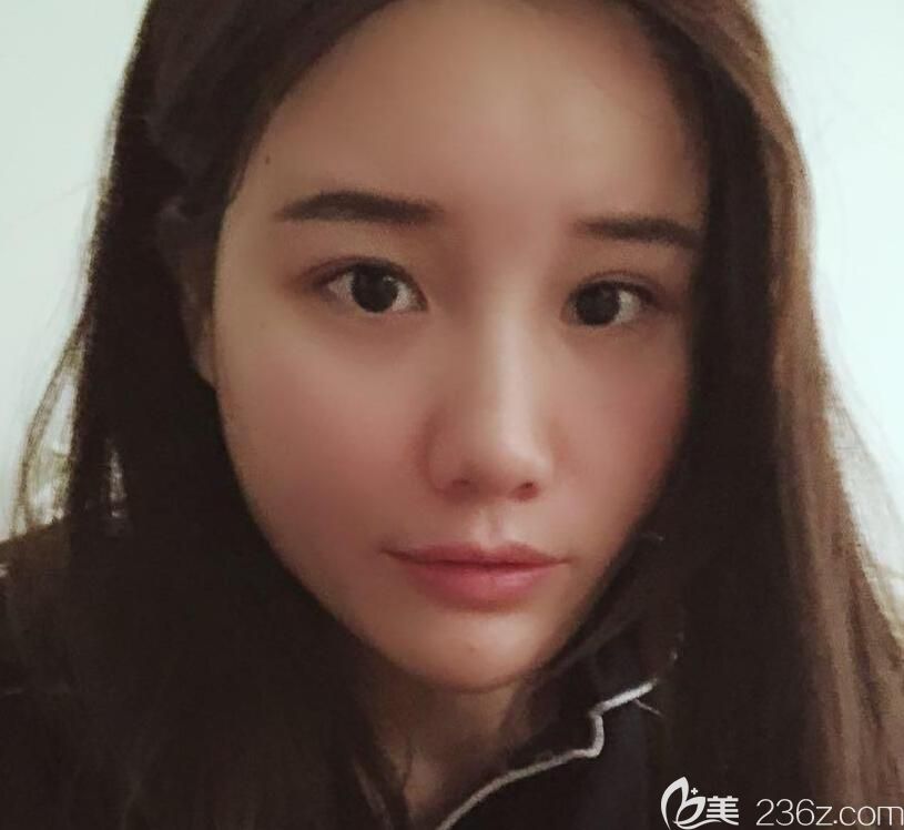 合肥白領(lǐng)安琪兒面部自體脂肪填充第7天效果