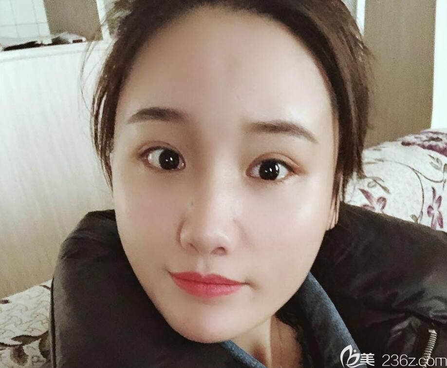 擔心黃山自體脂肪填充效果不好，專門去合肥找了安琪兒胡準院長做了全臉填充手術