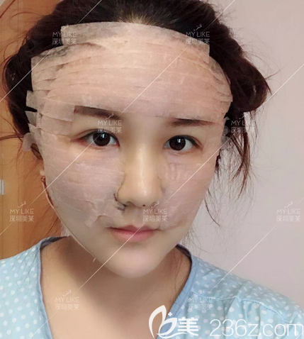 面部吸脂術(shù)后兩天恢復(fù)效果圖片 面部吸脂術(shù)后兩天恢復(fù)效果圖片