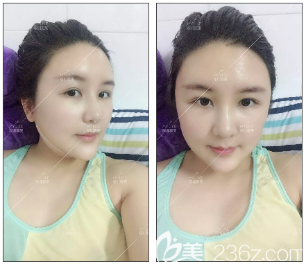 深圳美萊面部吸脂術(shù)后七天消腫效果 深圳美萊面部吸脂術(shù)后七天消腫效果