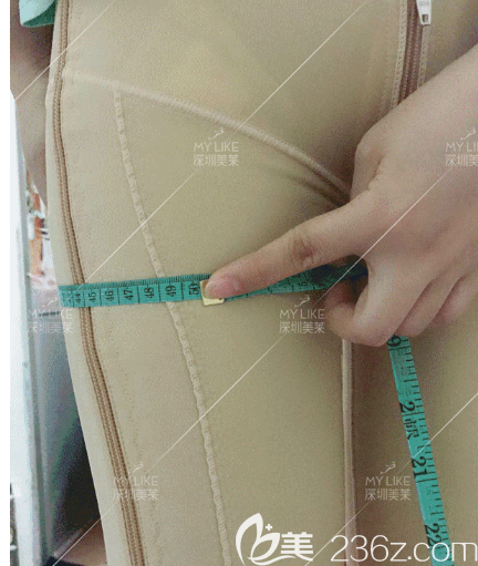 大腿腰腹吸脂術(shù)后13天效果圖 大腿腰腹吸脂術(shù)后13天效果圖