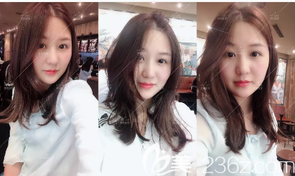 深圳美萊全身吸脂術(shù)后三個(gè)月反饋 深圳美萊全身吸脂術(shù)后三個(gè)月反饋