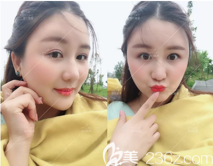 深圳美萊面部吸脂術(shù)后20天圖片 深圳美萊面部吸脂術(shù)后20天圖片