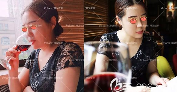 50歲的我不服老,來(lái)嘉興曙光做了祛眼袋和面部4D線雕提升術(shù),一個(gè)月效果出爐