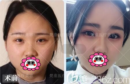 長沙梵童注射瘦臉瘦臉真人前后對比