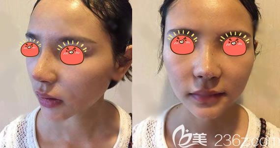 義烏連天美隆鼻<span style=