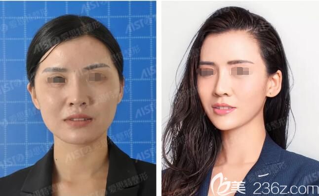 都說無錫愛思特高飛是亞太實力抗衰醫(yī)生看過對比照效果后立馬預約做了PPDO線雕提升面部年輕化項目