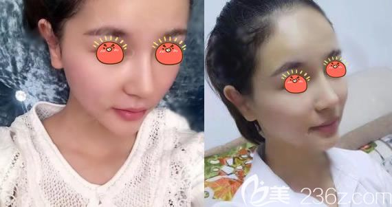 義烏連天美分院做隆鼻<span style=