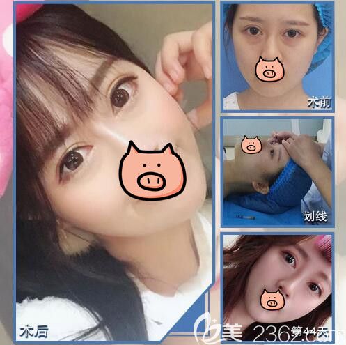 閨蜜給我看找黃名斗醫(yī)生做的韓式重瞼術(shù)后效果還分享南京美貝爾4月整形優(yōu)惠價(jià)格表