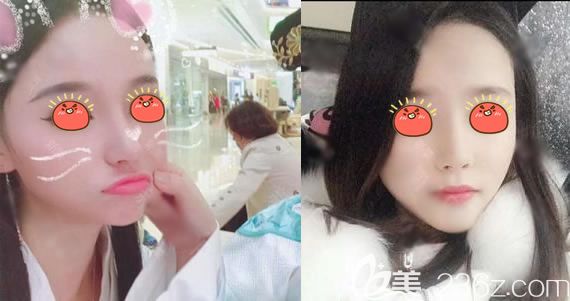 義烏連天美整形假體隆鼻<span style=