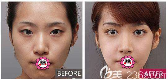 佳木斯韓藝來張海港雙眼皮案例效果