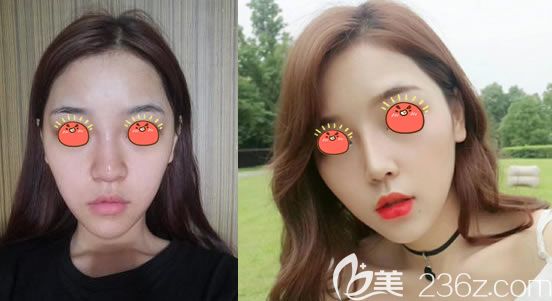 義烏連天美鼻綜合隆鼻<span style= 義烏連天美鼻綜合隆鼻<span style=