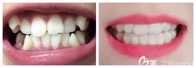 鄭州拜博口腔牙齒矯正案例效果