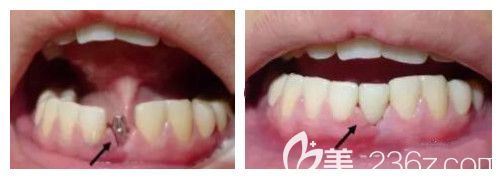 拜博口腔單顆種植牙案例