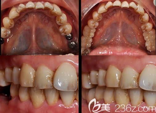 廣州圣貝口腔萬千醫(yī)師種植案例效果對比圖