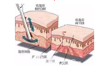 吸脂前后示意圖