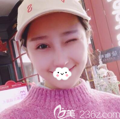 鼻綜合手術(shù)后一個月的恢復(fù)圖片