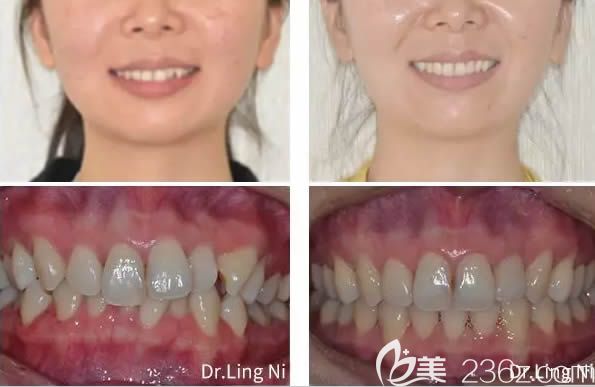 重慶維樂文林醫(yī)生成人深覆頜矯正臉型前后對比效果