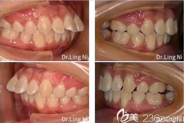 重慶維樂口腔醫(yī)院文林醫(yī)生成人齙牙矯正前后對比照