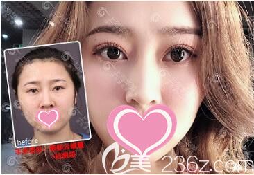 <!--<i data=20240703-sp></i>-->華美醫(yī)療美容醫(yī)院<!--<i data=20240703-sp></i>-->眼修復(fù)真人案例