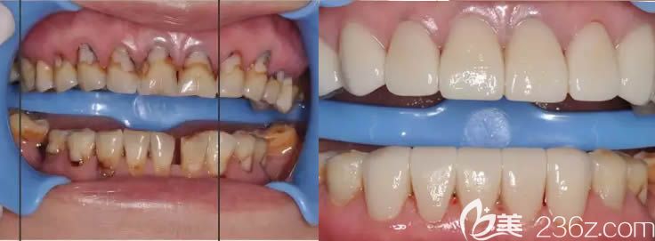 蔡菁菁醫(yī)師樹脂充填+全瓷冠修復(fù)案例效果對比圖