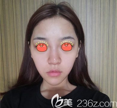 義烏連天美做鼻綜合隆鼻術(shù)前 義烏連天美做鼻綜合隆鼻術(shù)前