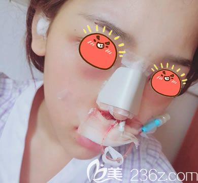 義烏連天美隆鼻<span style= 義烏連天美隆鼻<span style=