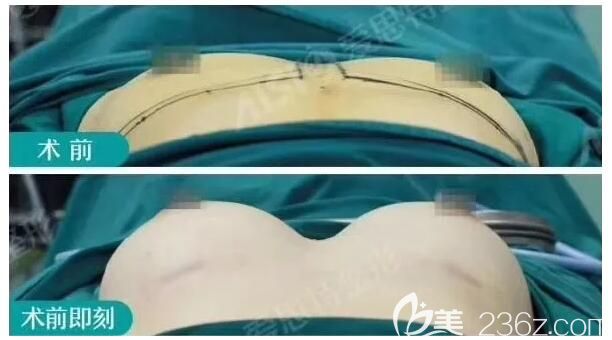 剛做完假體隆胸和術(shù)前效果對比 剛做完假體隆胸和術(shù)前效果對比