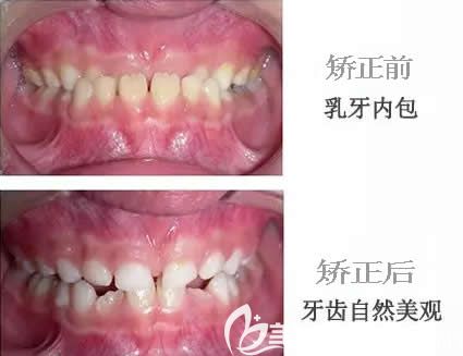 鄭州拜博口腔齊鵬飛醫(yī)生乳牙矯正案例 鄭州拜博口腔齊鵬飛醫(yī)生乳牙矯正案例