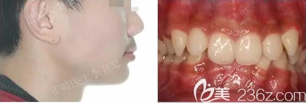 深覆頜矯正前的樣子 深覆頜矯正前的樣子