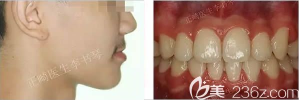 深覆頜矯正后的效果圖 深覆頜矯正后的效果圖