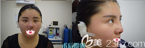 唯美整形醫(yī)生應勝華做耳軟骨隆鼻術后即刻效果 唯美整形醫(yī)生應勝華做耳軟骨隆鼻術后即刻效果