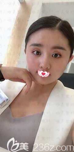 衡水唯美應勝華醫(yī)生采用自體耳軟骨隆鼻術(shù)為我打造可以揉捏的人工美鼻