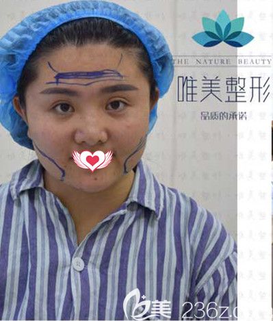 應勝華醫(yī)生為我做術前隆鼻設計 應勝華醫(yī)生為我做術前隆鼻設計