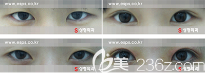 韓國(guó)s整形外科雙眼皮手術(shù)案例