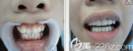 重慶維樂口腔醫(yī)院許凈雯醫(yī)生兒童牙齒擁擠矯正前后對(duì)比效果