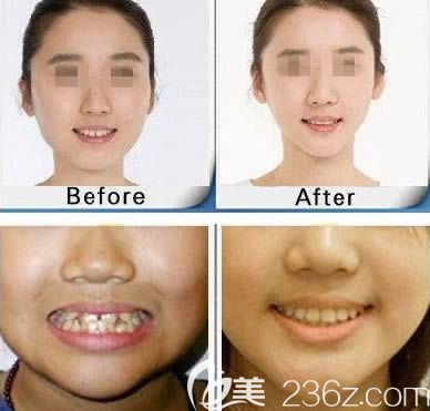 廈門登特口腔羅艷平牙齒正畸案例效果對比圖 廈門登特口腔羅艷平牙齒正畸案例效果對比圖