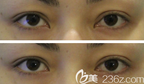 韓國右手整形開內(nèi)眼角失敗修復(fù)手術(shù)效果對比圖 韓國右手整形開內(nèi)眼角失敗修復(fù)手術(shù)效果對比圖