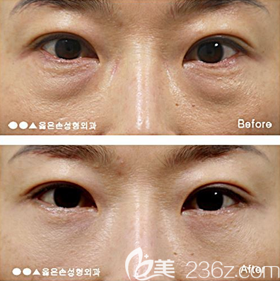 韓國右手整形外科去眼袋+下眼瞼矯正案例前后效果對比圖 韓國右手整形外科去眼袋+下眼瞼矯正案例前后效果對比圖