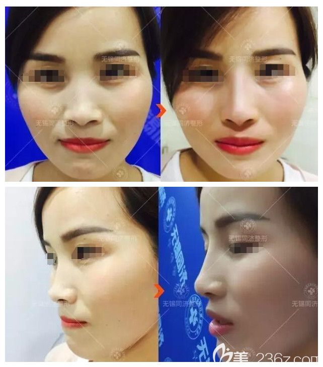 愛芙萊指定注射醫(yī)生彭建分享玻尿酸注射隆鼻全過程 體驗(yàn)者看到術(shù)后效果對(duì)無(wú)錫同舟整形醫(yī)院點(diǎn)贊