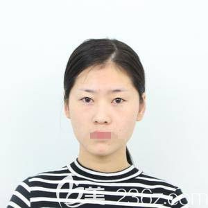 在鄭州華領(lǐng)做自體脂肪填充和眼綜合前 在鄭州華領(lǐng)做自體脂肪填充和眼綜合前